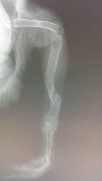 Radiographs show multiple breaks