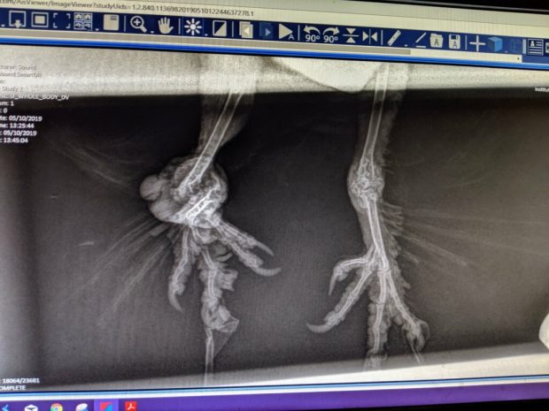 A radiograph showing a jumble of broken & mis-positioned bones fused into an unuseable mess